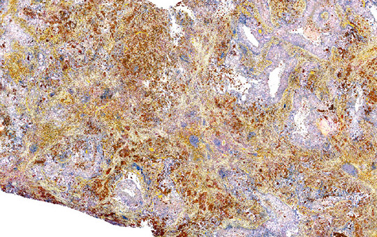 Lung Adenocarcinoma: CD163, CD68, PD-L1